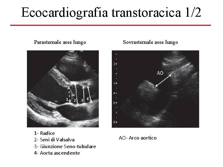 Ecocardiografia transtoracica 1/2 Parasternale asse lungo 1 2 Sovrasternale asse lungo 3 4 1