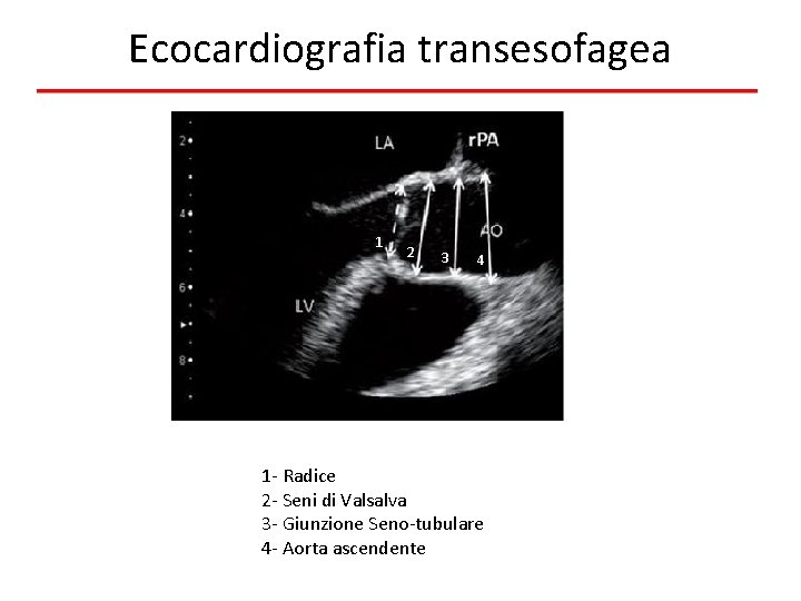 Ecocardiografia transesofagea 1 2 3 4 1 - Radice 2 - Seni di Valsalva