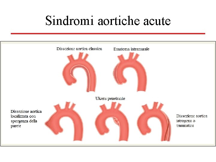 Sindromi aortiche acute 