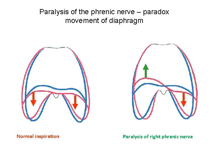 Paralysis of the phrenic nerve – paradox movement of diaphragm Normal inspiration Paralysis of