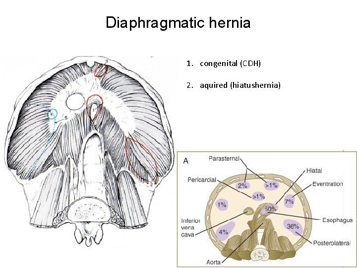 Diaphragmatic hernia 1. congenital (CDH) 2. aquired (hiatushernia) 