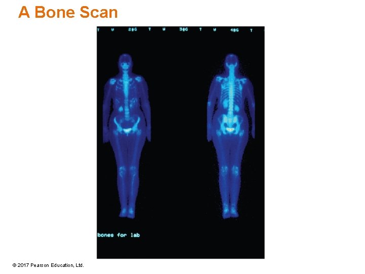 A Bone Scan © 2017 Pearson Education, Ltd. A Bone Scan © 2017 Pearson Education, Ltd.