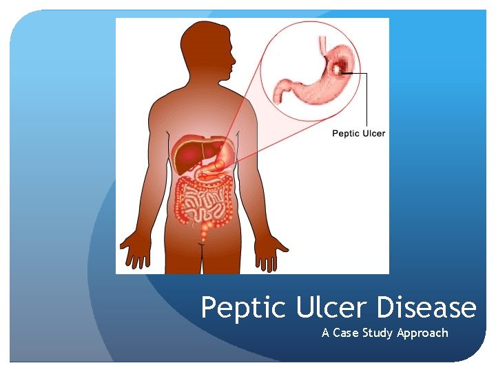 Peptic Ulcer Disease A Case Study Approach 