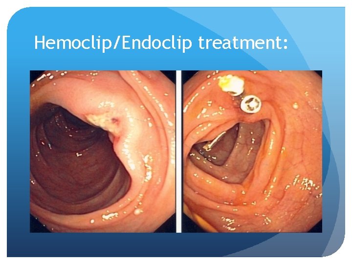 Hemoclip/Endoclip treatment: 