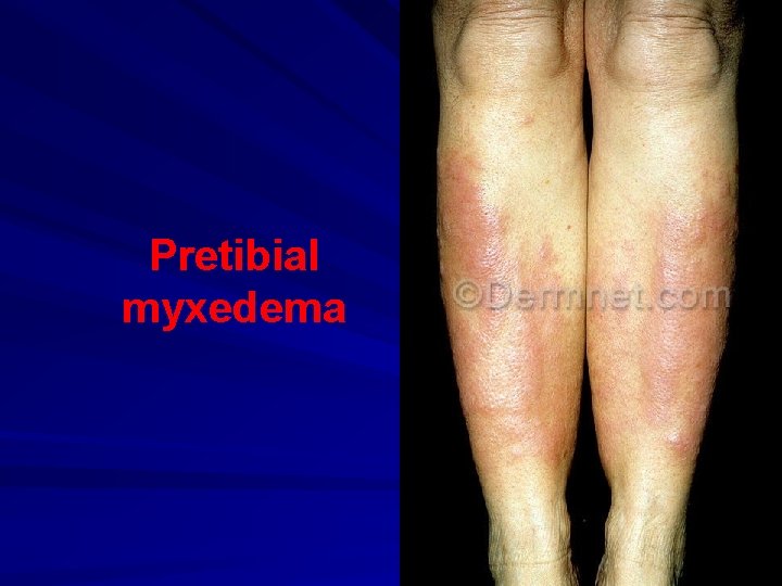 Pretibial myxedema 