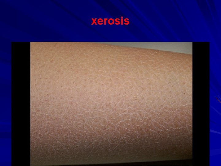 xerosis 