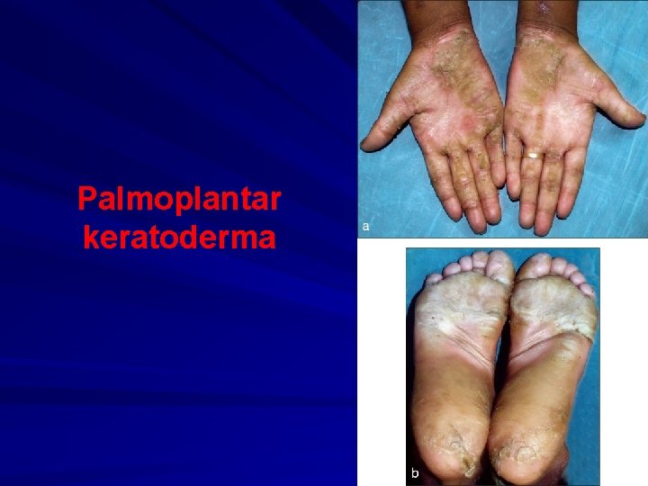 Palmoplantar keratoderma 