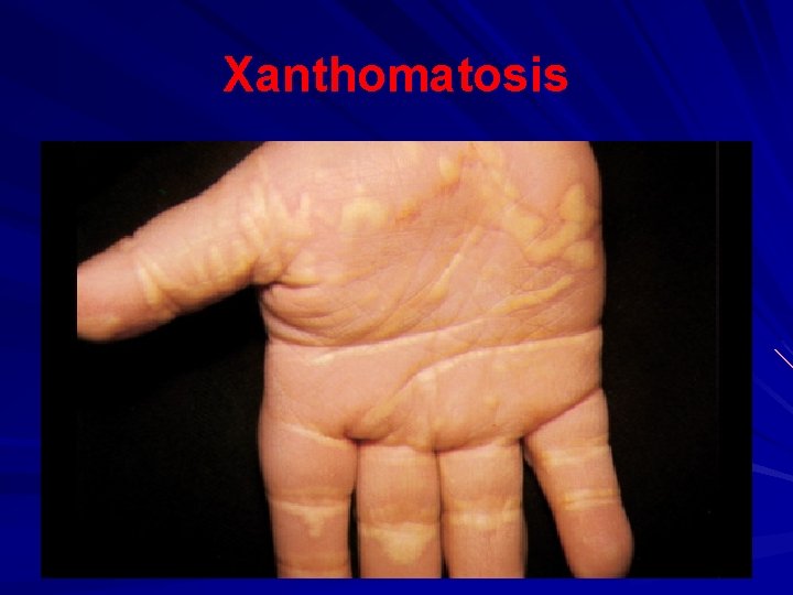 Xanthomatosis 