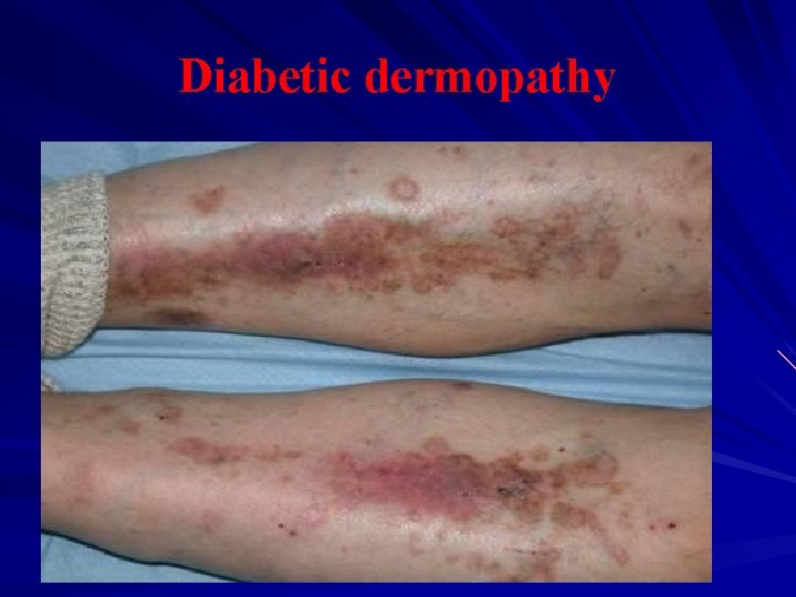 Diabetic dermopathy 