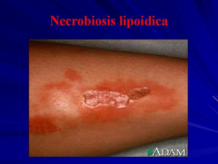 Necrobiosis lipoidica 