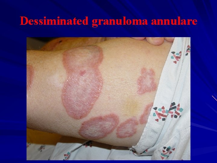 Dessiminated granuloma annulare 