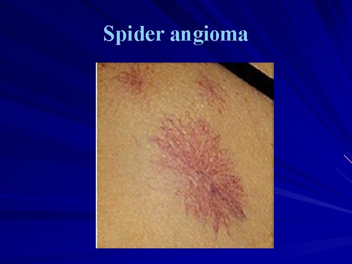 Spider angioma 