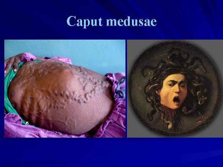Caput medusae Caput medusae