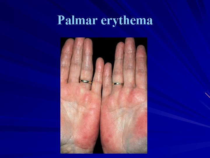 Palmar erythema 