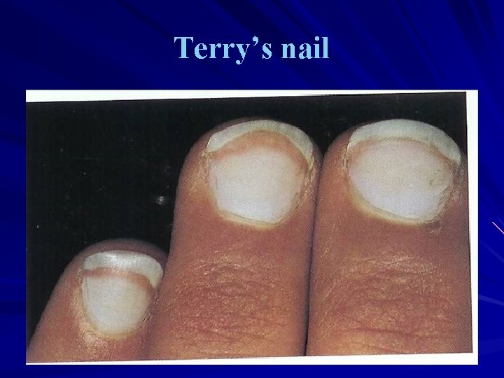 Terry’s nail 