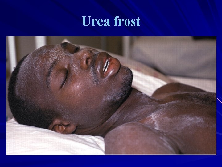 Urea frost 