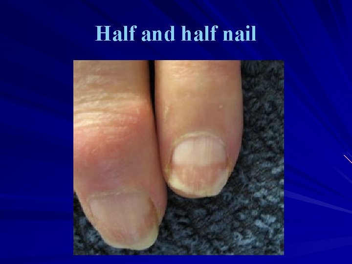 Half and half nail 