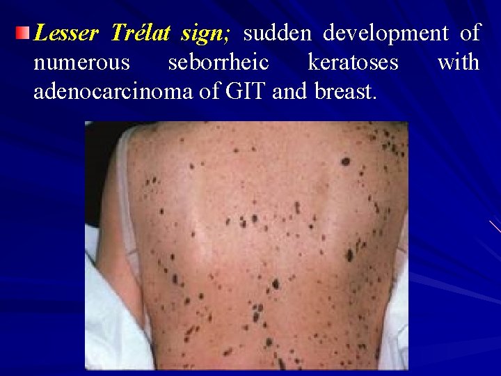 Lesser Trélat sign; sudden development of numerous seborrheic keratoses with adenocarcinoma of GIT and