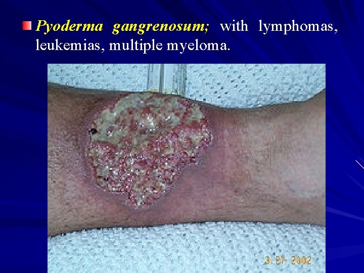 Pyoderma gangrenosum; with lymphomas, leukemias, multiple myeloma. 