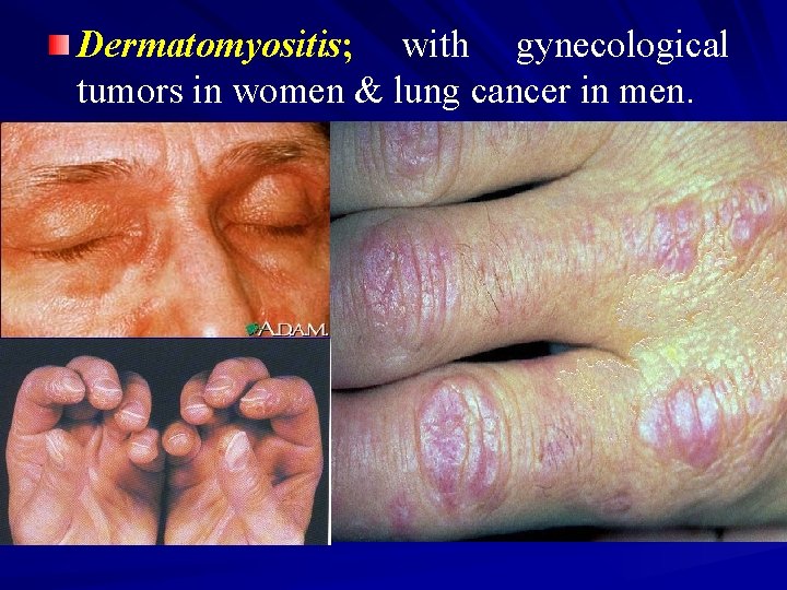 Dermatomyositis; with gynecological tumors in women & lung cancer in men. 