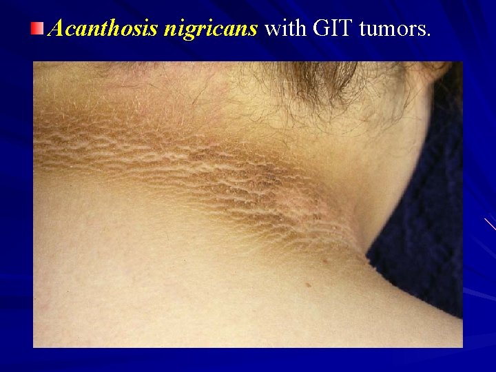 Acanthosis nigricans with GIT tumors. 