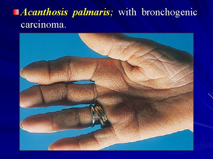 Acanthosis palmaris; with bronchogenic carcinoma. 