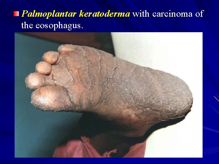 Palmoplantar keratoderma with carcinoma of the eosophagus. 