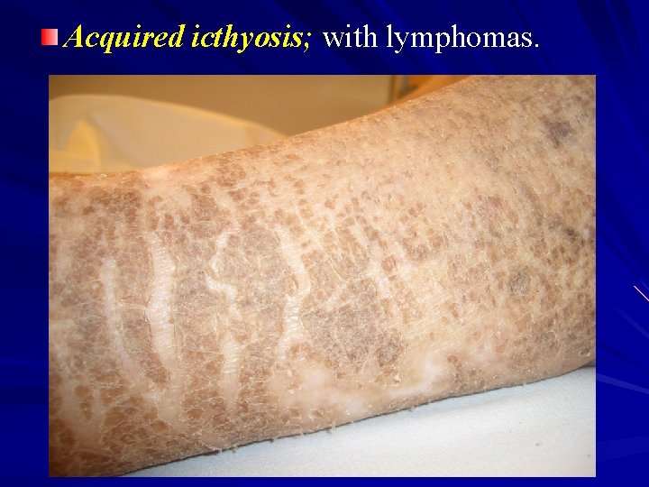 Acquired icthyosis; with lymphomas. 