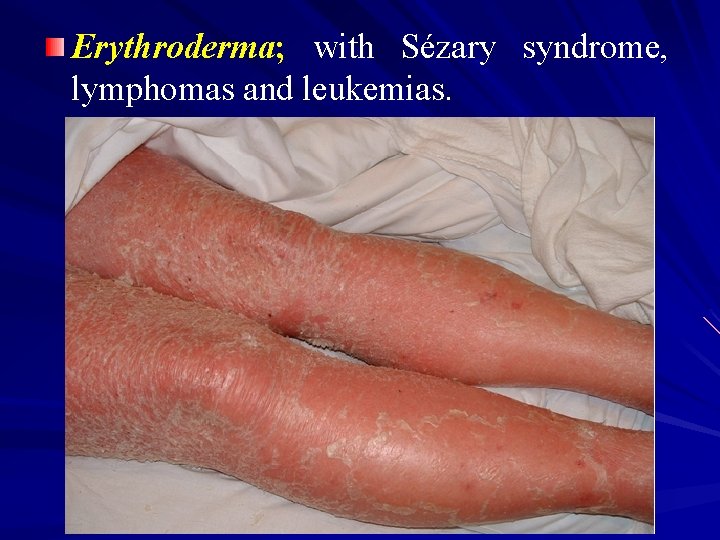 Erythroderma; with Sézary syndrome, lymphomas and leukemias. 