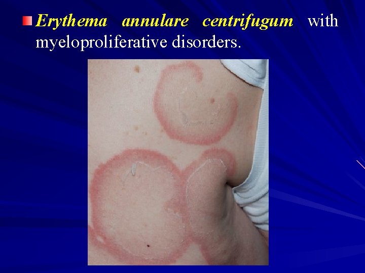 Erythema annulare centrifugum with myeloproliferative disorders. 