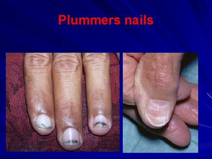 Plummers nails 