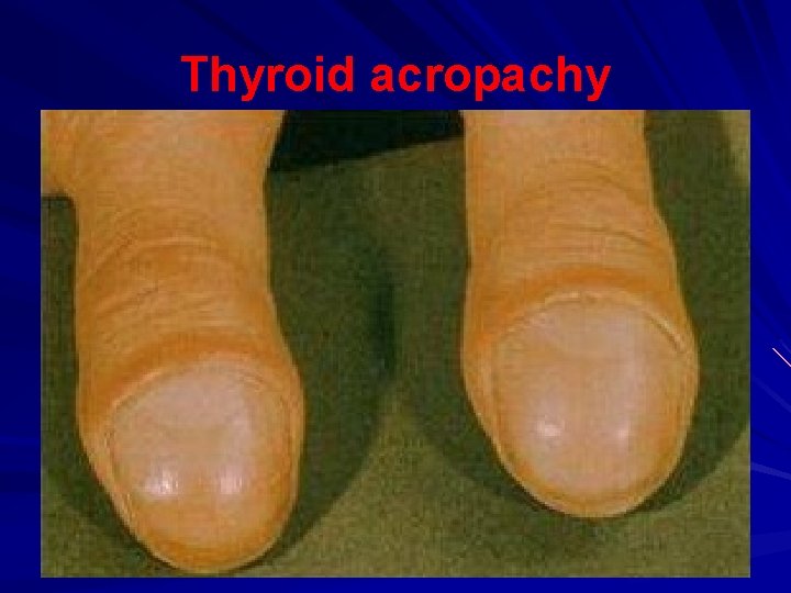 Thyroid acropachy 