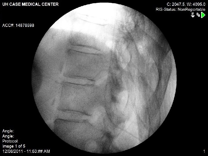 Dorsal Rootlets (sensory) Bupivacaine Opioids Clonidine RG D Ventral Rootlets (motor) Ziconotide Dorsal Rootlets