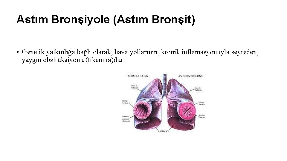 Astım Bronşiyole (Astım Bronşit) • Genetik yatkınlığa bağlı olarak, hava yollarının, kronik inflamasyonuyla seyreden,