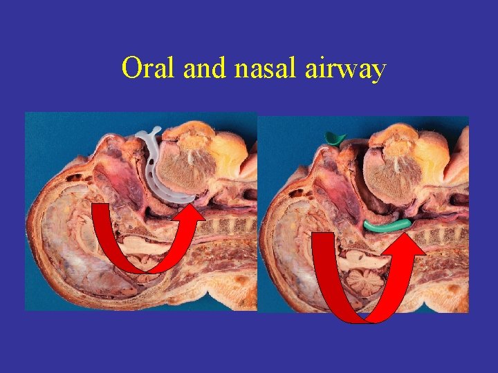 Oral and nasal airway 