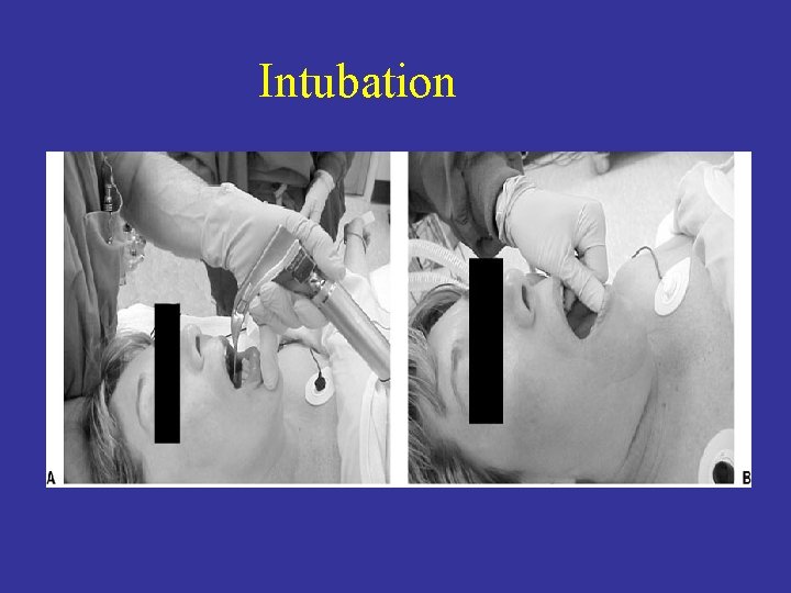Intubation 