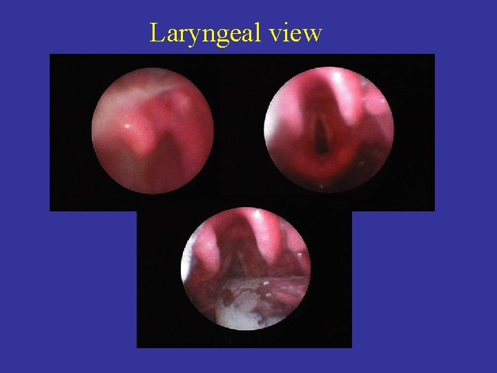 Laryngeal view 