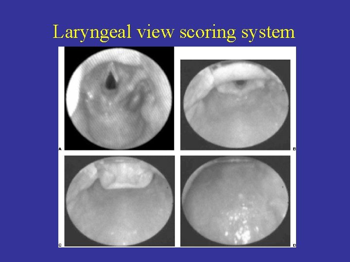 Laryngeal view scoring system 