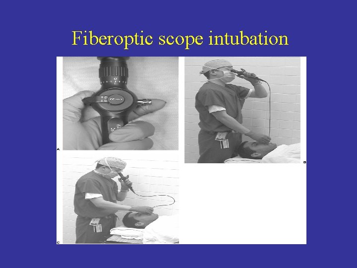 Fiberoptic scope intubation 
