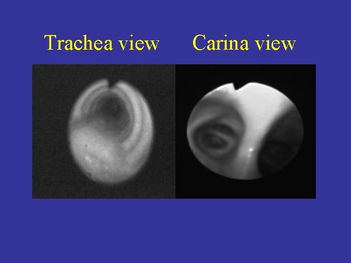 Trachea view Carina view 