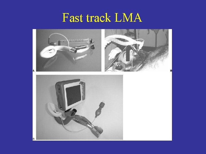 Fast track LMA 