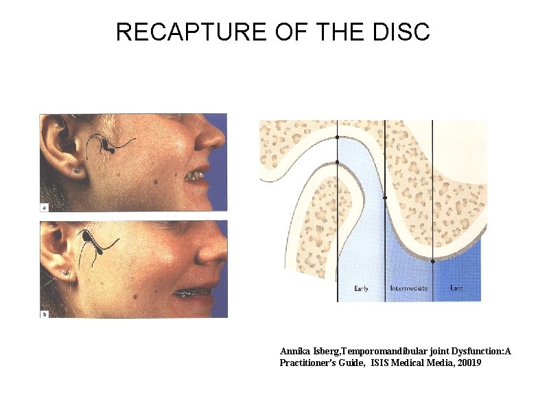 RECAPTURE OF THE DISC Annika Isberg, Temporomandibular joint Dysfunction: A Practitioner's Guide, ISIS Medical