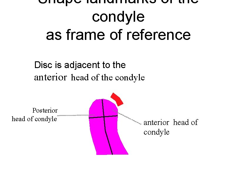 Shape landmarks of the condyle as frame of reference Disc is adjacent to the