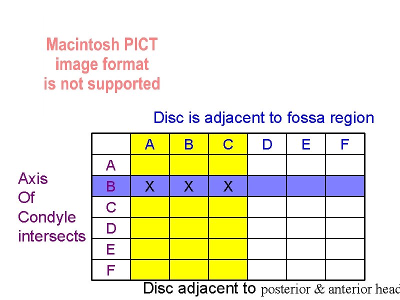 Disc is adjacent to fossa region Axis Of Condyle intersects A B C D