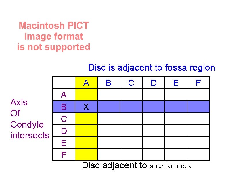 Disc is adjacent to fossa region A Axis Of Condyle intersects A B C