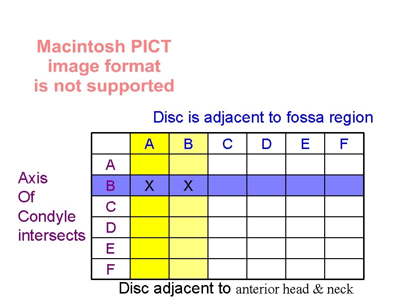 Disc is adjacent to fossa region Axis Of Condyle intersects A B C D