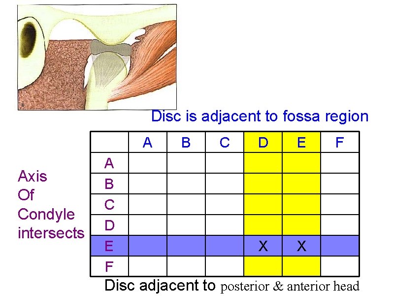Disc is adjacent to fossa region A Axis Of Condyle intersects A B C