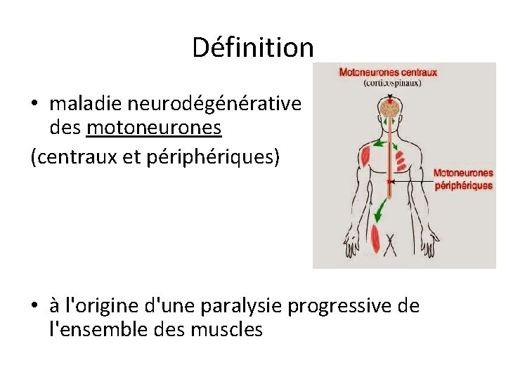 Définition • maladie neurodégénérative des motoneurones (centraux et périphériques) • à l'origine d'une paralysie