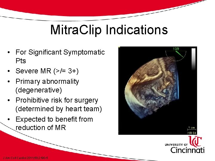 Mitra. Clip Indications • For Significant Symptomatic Pts • Severe MR (>/= 3+) •