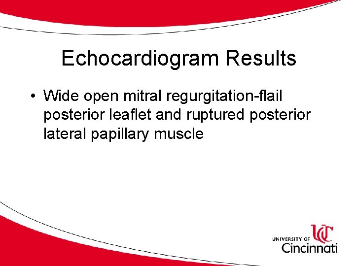 Echocardiogram Results • Wide open mitral regurgitation-flail posterior leaflet and ruptured posterior lateral papillary